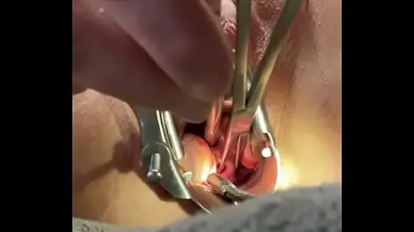 Friss Holding cervix w tenaculum while 8mm dilator fucks uterus legjobb videók